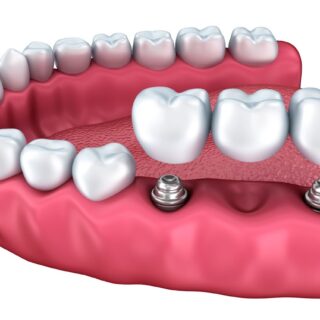 implants dentaires valenciennes